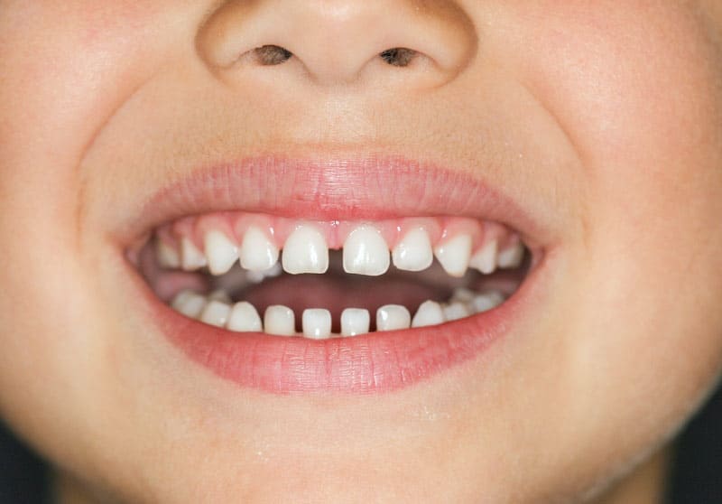 Baby teeth with normal space