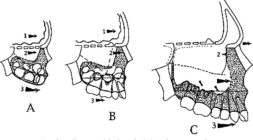 diagram of maxillary growth direction